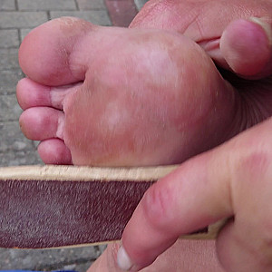 Callus on right foot gallery image