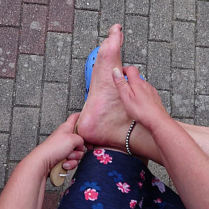 Callus on right foot gallery image